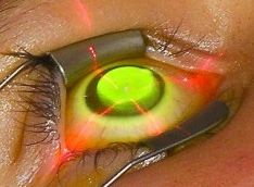 El queratocono es una enfermedad de la cornea