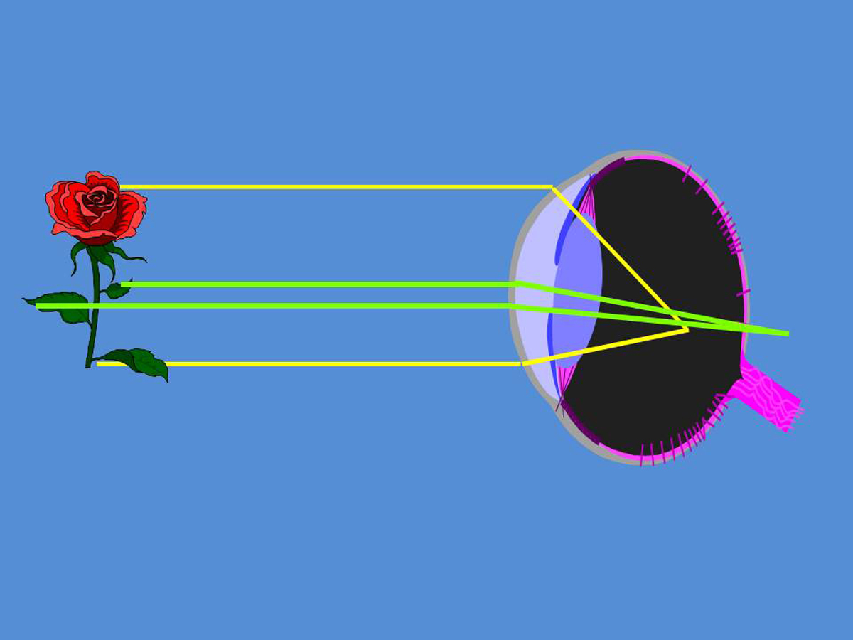 El astigmatismo es un defecto visual refractivo frecuentemente asociado a miopía o a hipermetropía