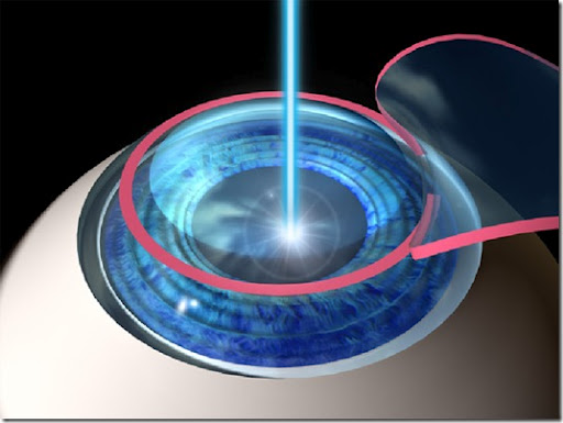 Cirugía refractiva Lasik.Esta técnica permite moldear la superficie de la córnea con un láser para corregir el defecto refractivo del paciente.