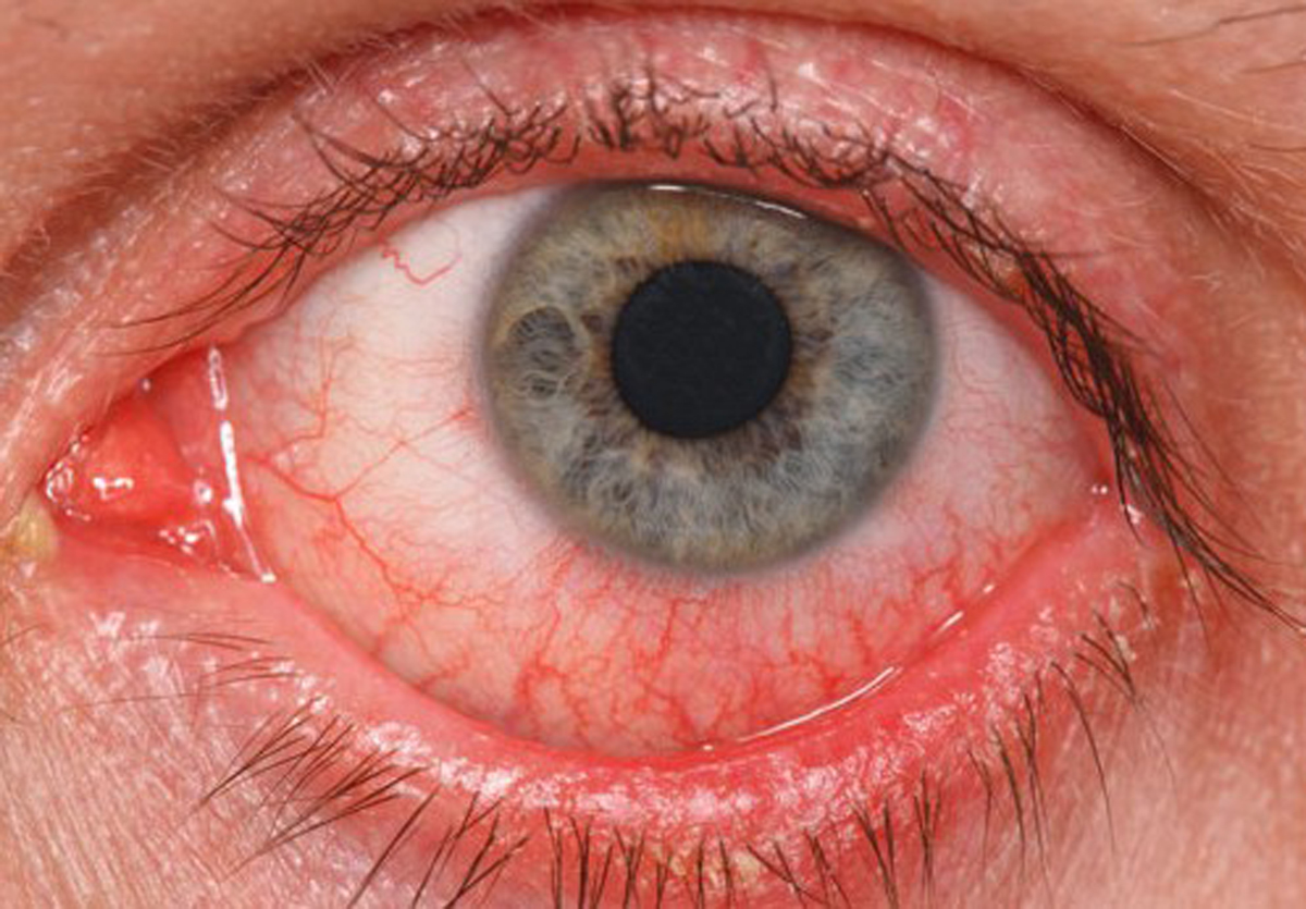 La conjuntivitis es una inflamación de la conjuntiva