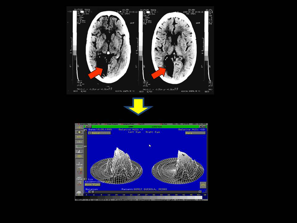 Los derrames producen hemianopsia