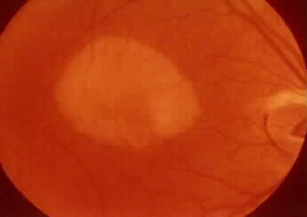 Desprendimiento seroso epitelio pigmentario de retina