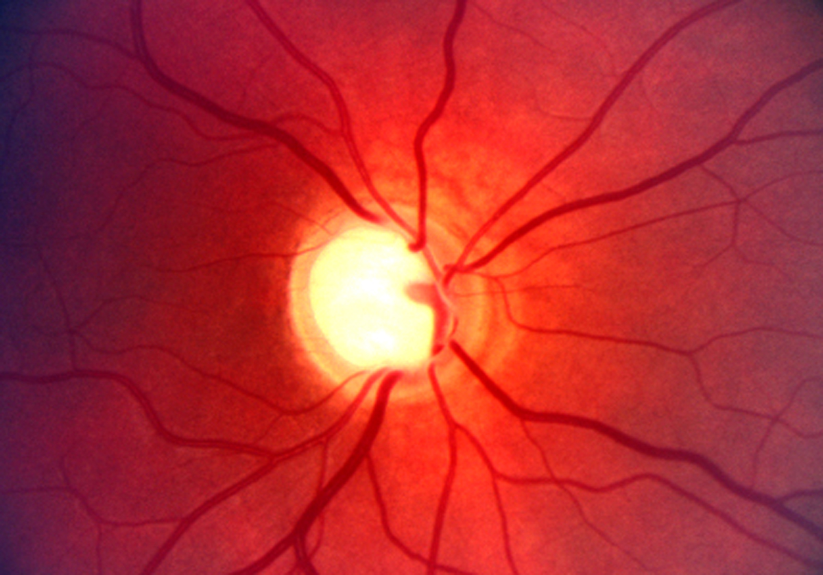 El glaucoma es una enfermedad que consiste en una elevación de la presión del globo ocular.