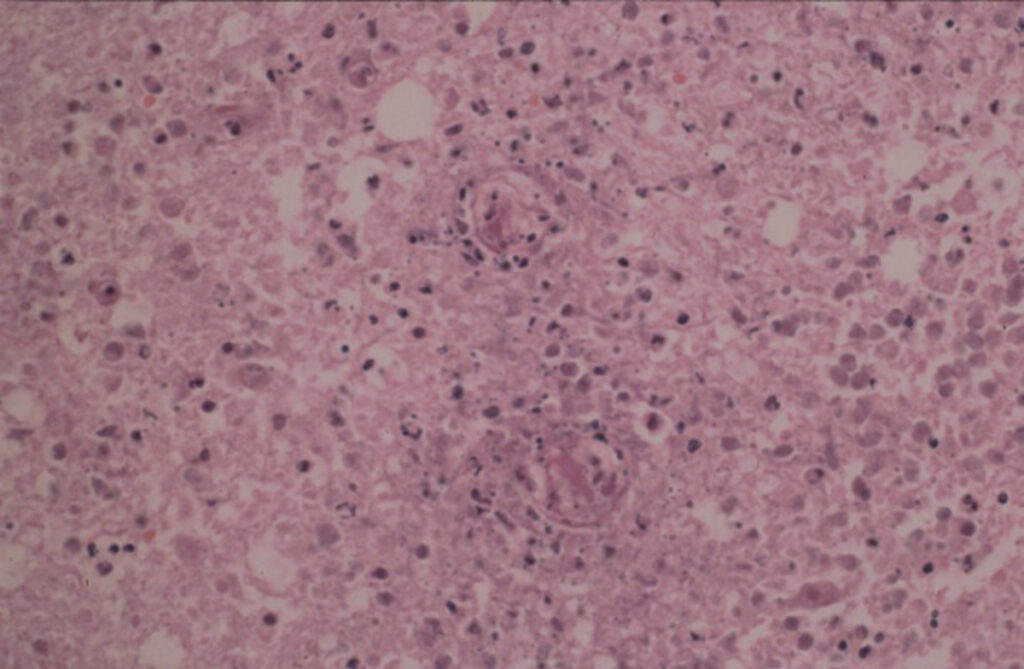 Hemianópsia. Biopsia encefalitis herpetica