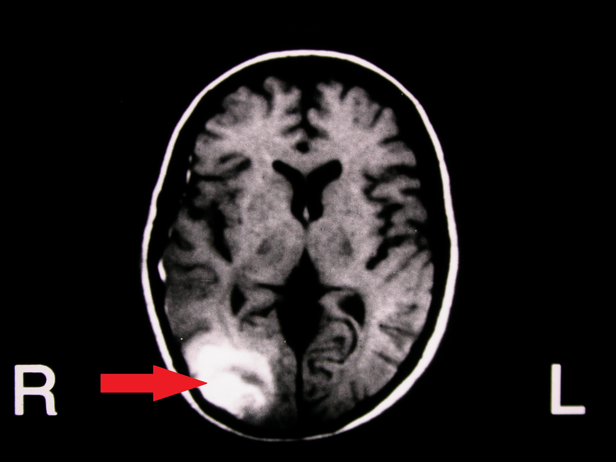 Hemianopsia TAC lesión lóbulo occipital derecho