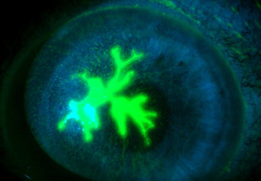 Herpes corneal