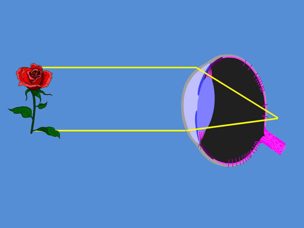 La hipermetropía es un defecto visual refractivo actualmente menos común que la miopía en la población.