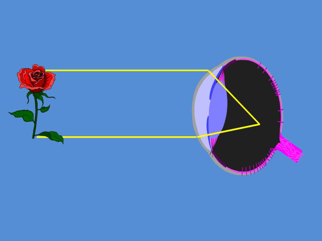 La miopía es uno de los defectos visuales refractivos más comunes de la población