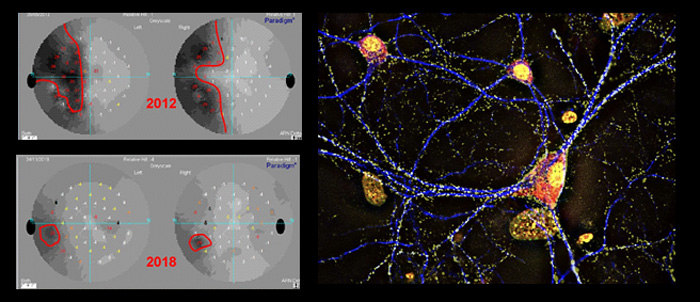 Neurorehabilitación visual