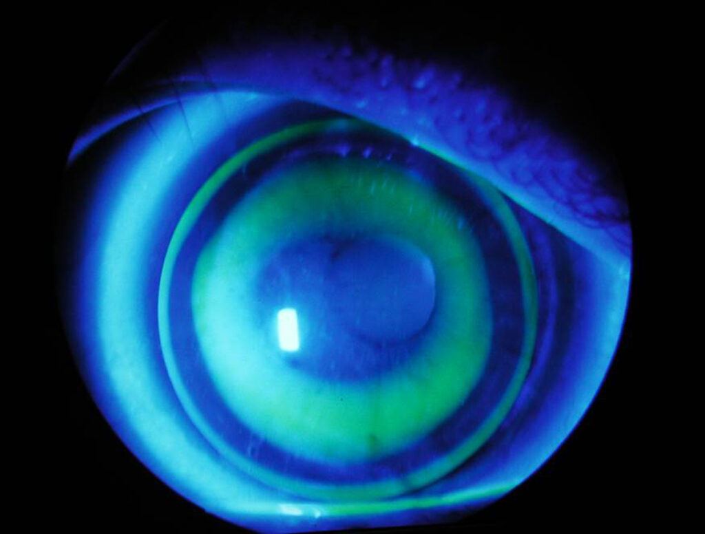 La ortoqueratología, también conocida como orto-k, es un tratamiento que utiliza lentes de contacto rígidos permeables al gas