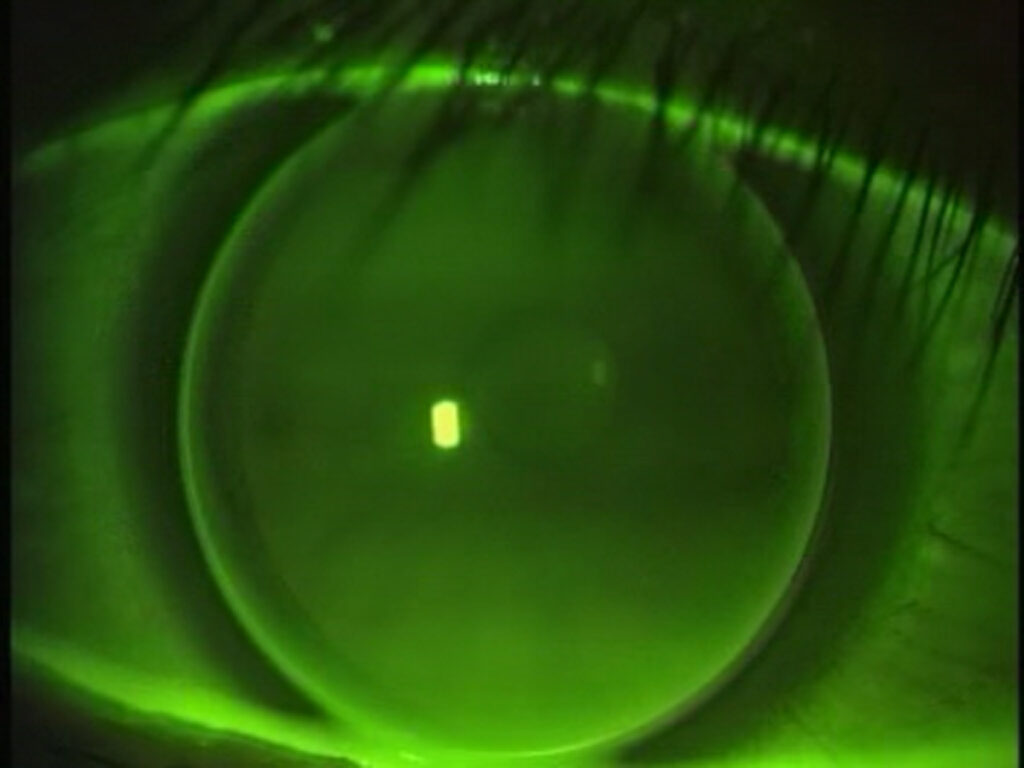 La Ortoqueratología consiste en la adaptación de una lente de contacto de geometría especial durante la noche, para dormir