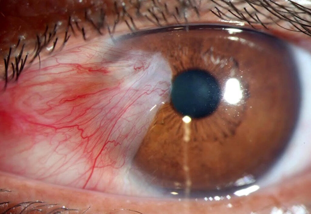 Paciente con pterigium