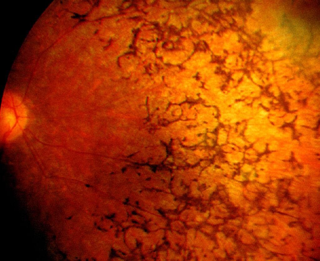 Retinosis pigmentaria