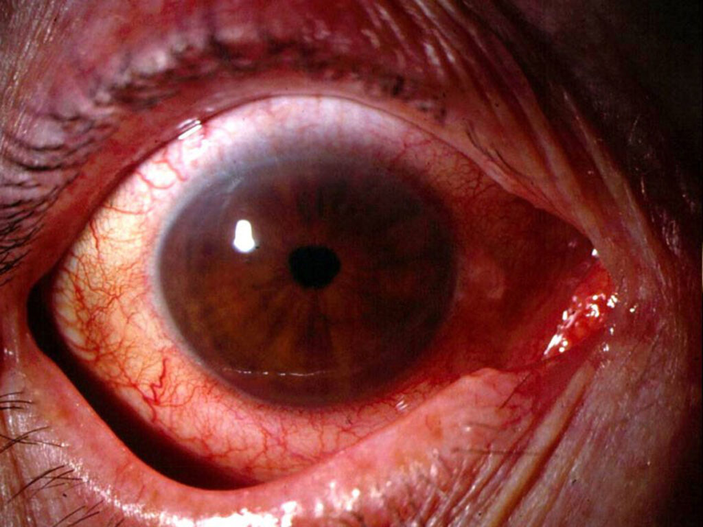 Paciente con uveitis