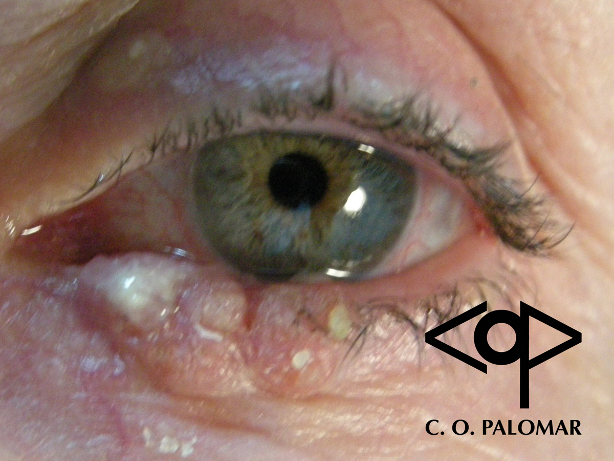 Carcinoma escamoso intraepitelial