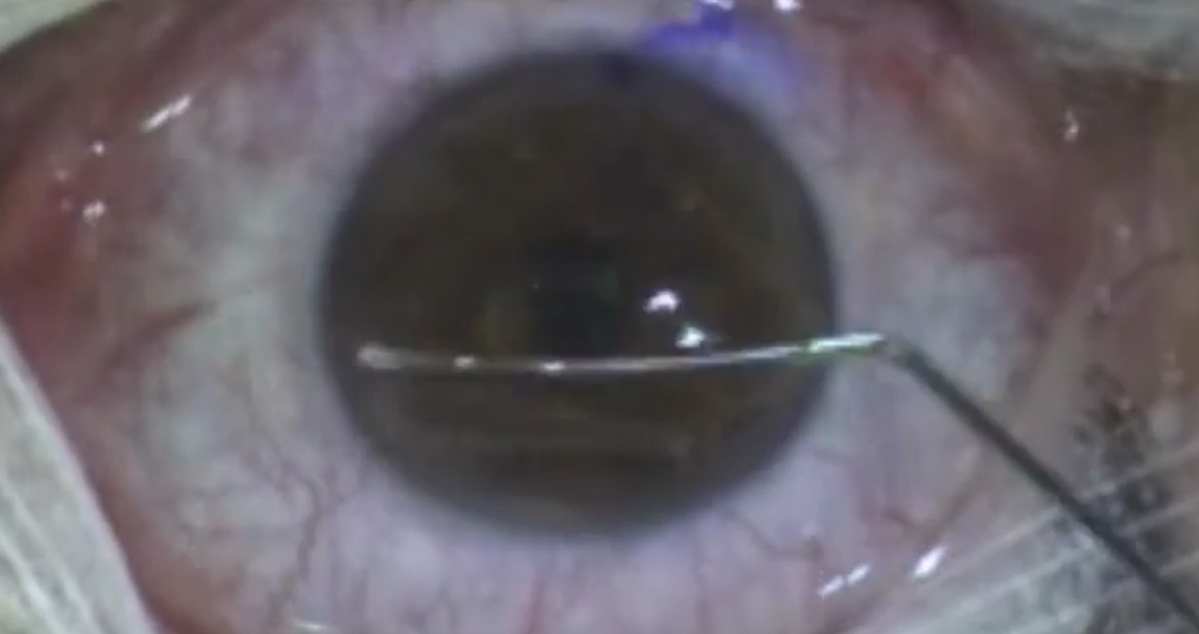 Cirugía refractiva Lasik