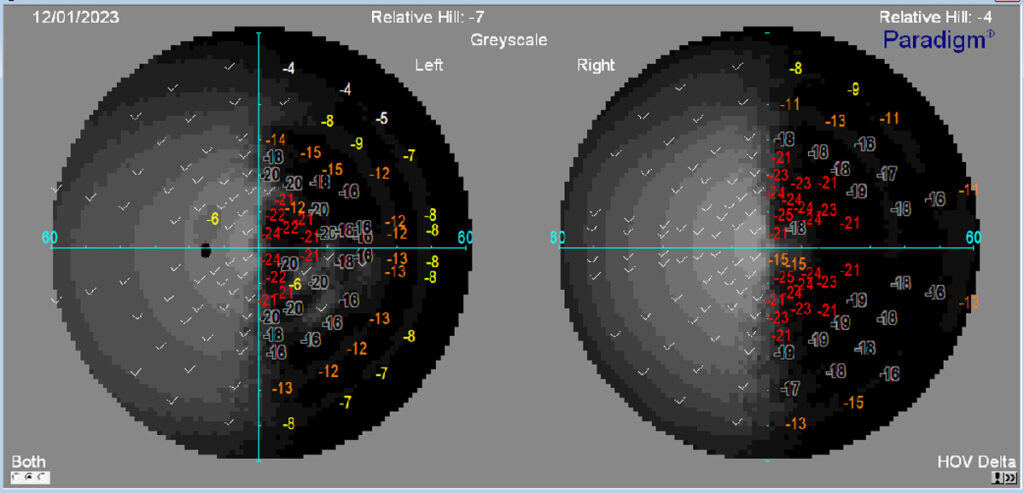 Hemianopsia derecha campimetria.La hemianopsia homónima completa derecha, es una alteración caracterizada por una reducción de campo visual derecho