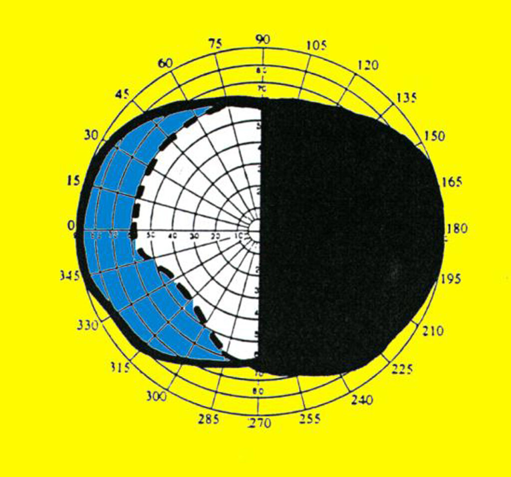 Hemianopsia derecha campo binocular.Al superponer los campos visuales de uno y otro ojo resulta el campo visual binocular, que se verá afectado en el caso de una HHC  derecha, con una pérdida de su mitad derecha.
