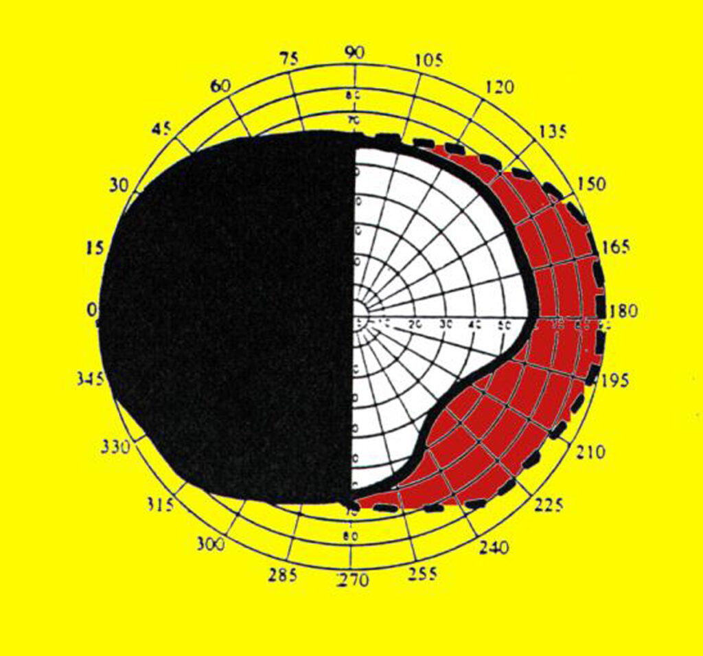 Hemianopsia izquierda campo binocular.Al superponer los campos visuales de uno y otro ojo resulta el campo visual binocular, que se verá afectado en el caso de una HHC izquierda, con una pérdida de su mitad izquierda.