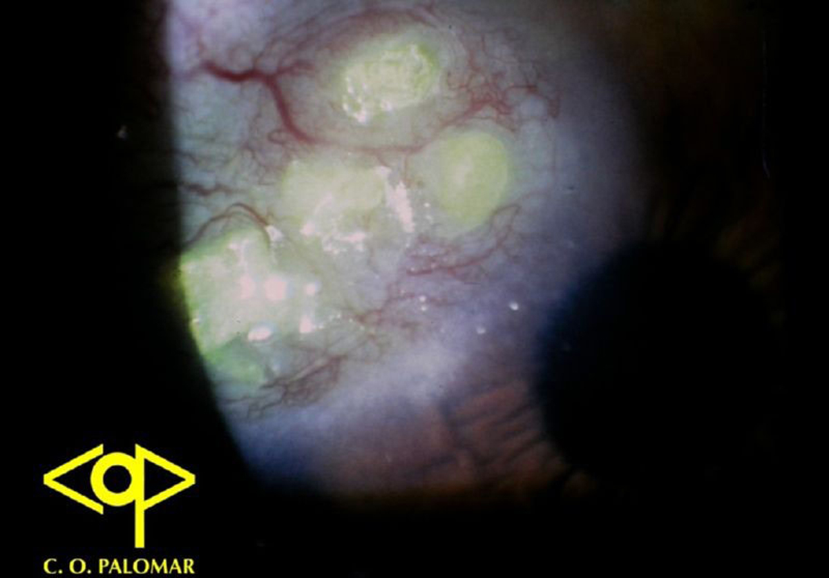 Herpes necrotico