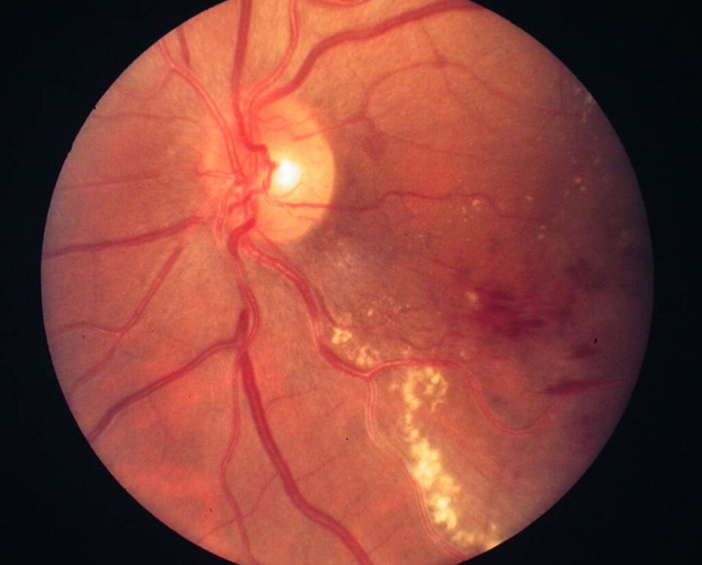 Retinopatía diabética.La diabetes mellitus es un desorden del metabolismo.