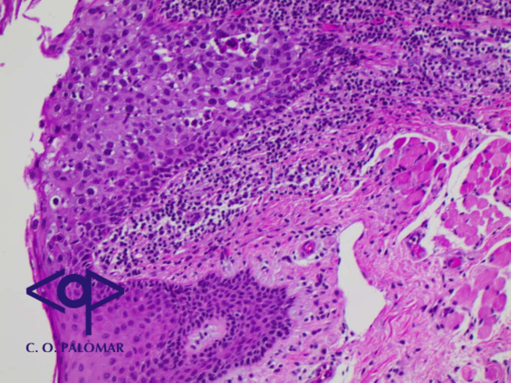 Tinción de papanicolau carcinoma escamoso palpebral