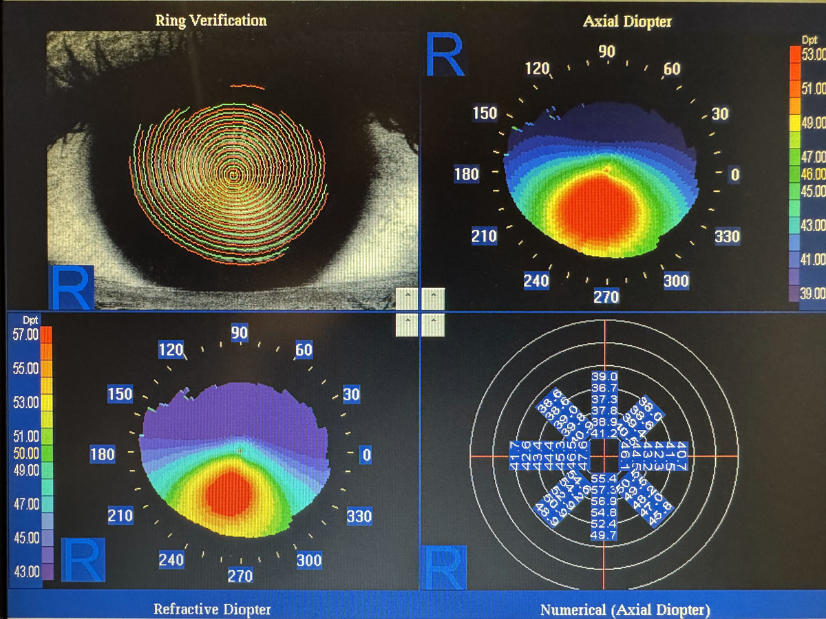 Topografia corneal. Queratocono.