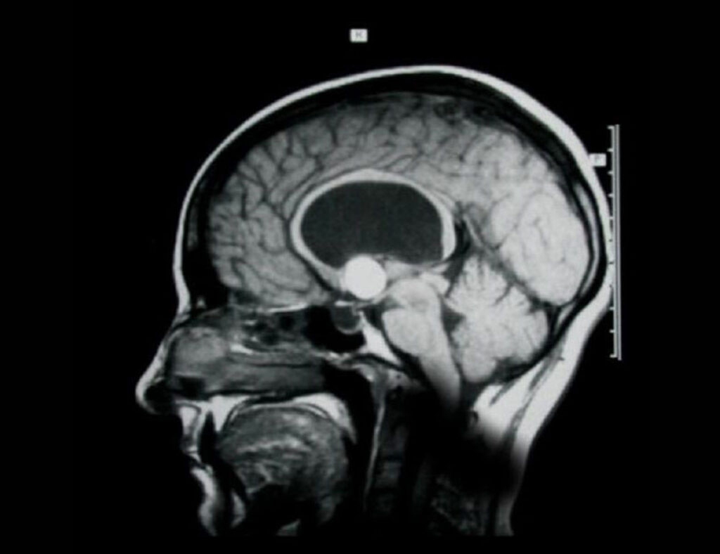 Tumor intracraneal